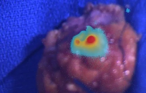 Cette image montre une vue des lunettes de vision médicales d’une tumeur mammaire retirée lors d’une mastectomie partielle. Les cellules cancéreuses sont mises en valeur par un colorant : le rouge indique une forte concentration de cellules cancéreuses, le jaune en indique moins, et le bleu met en valeur les zones sans cellules cancéreuses détectables.